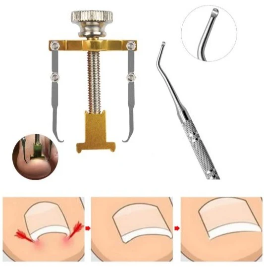 Kit Corrector Reparador de Uñas Encarnadas + Varilla Pedicura