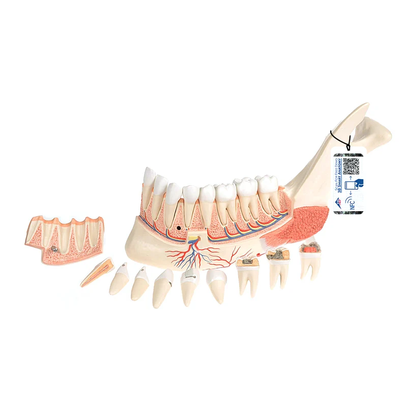Mitad de la mandíbula inferior con 8 dientes cariados, 19 piezas - 3B Smart Anatomy