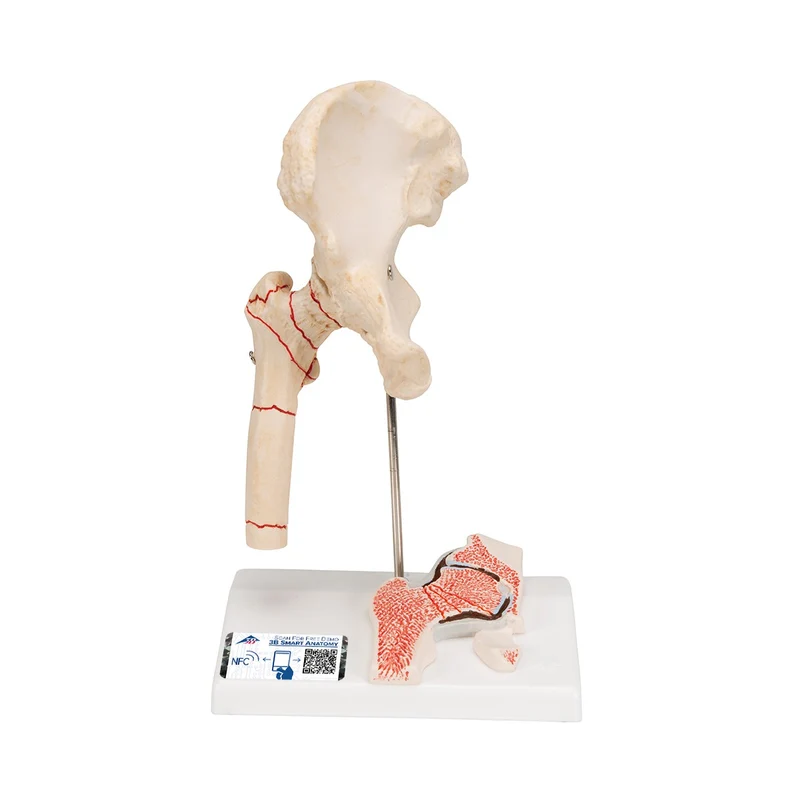 Fractura de fémur y desgaste de la articulación de la cadera - 3B Smart Anatomy