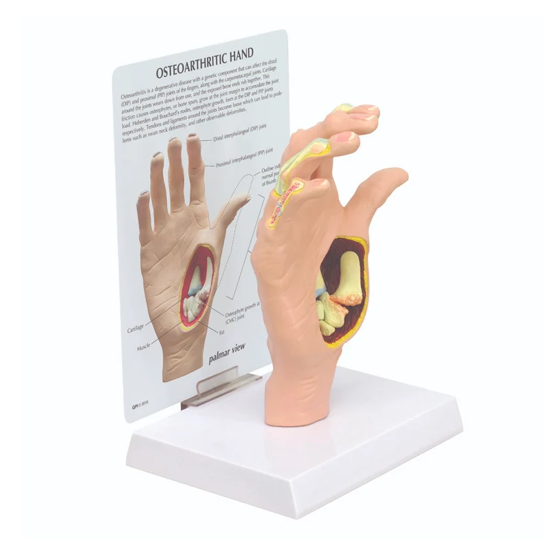 Modelo de mano con osteoartritis