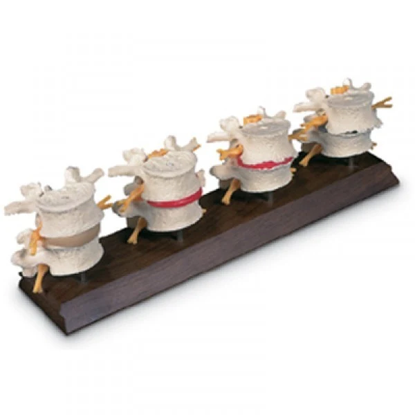 Modelo de la degeneración de las vertebras lumbares en 4 etapas